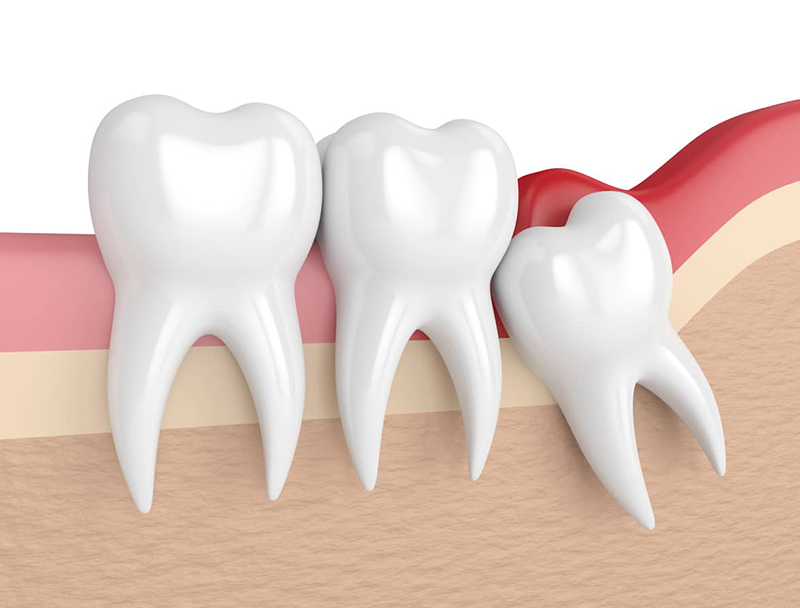 Nhổ răng khôn có được BHYT chi trả không? - Ảnh 1.