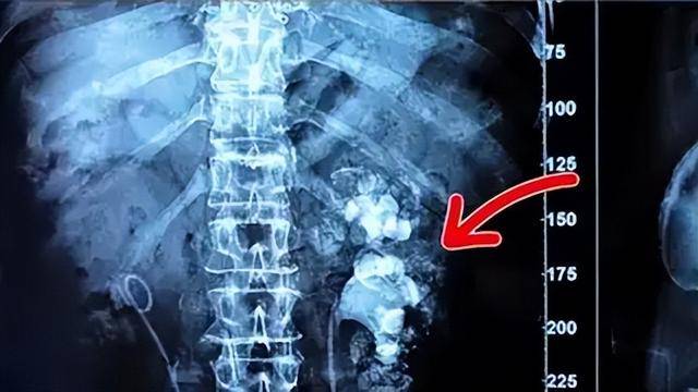 9 năm “nghiện” trà sữa thay nước lọc, uống tới 3.000 cốc: Người phụ nữ biến hai quả thận thành... túi đựng sỏi- Ảnh 1.