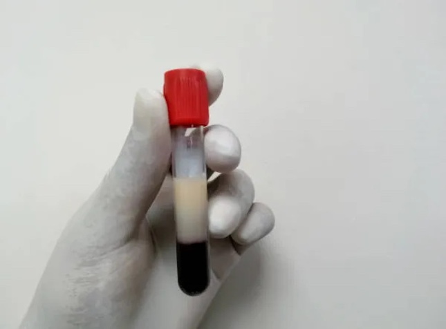 Người đàn ông 28 tuổi máu ngập mỡ, nhớt như dầu: Tất cả tại 2 món khoái khẩu và 2 loại nước "vạn người mê"- Ảnh 1.