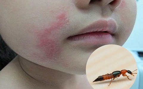 Bác sĩ BV Bạch Mai cảnh báo căn bệnh viêm da do một loại côn trùng gây ra: Cực độc, rất dễ nhầm lẫn với bệnh Zona và gặp nhiều vào mùa hè - Ảnh 3.