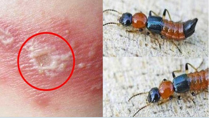 Bác sĩ BV Bạch Mai cảnh báo căn bệnh viêm da do một loại côn trùng gây ra: Cực độc, rất dễ nhầm lẫn với bệnh Zona và gặp nhiều vào mùa hè - Ảnh 1.