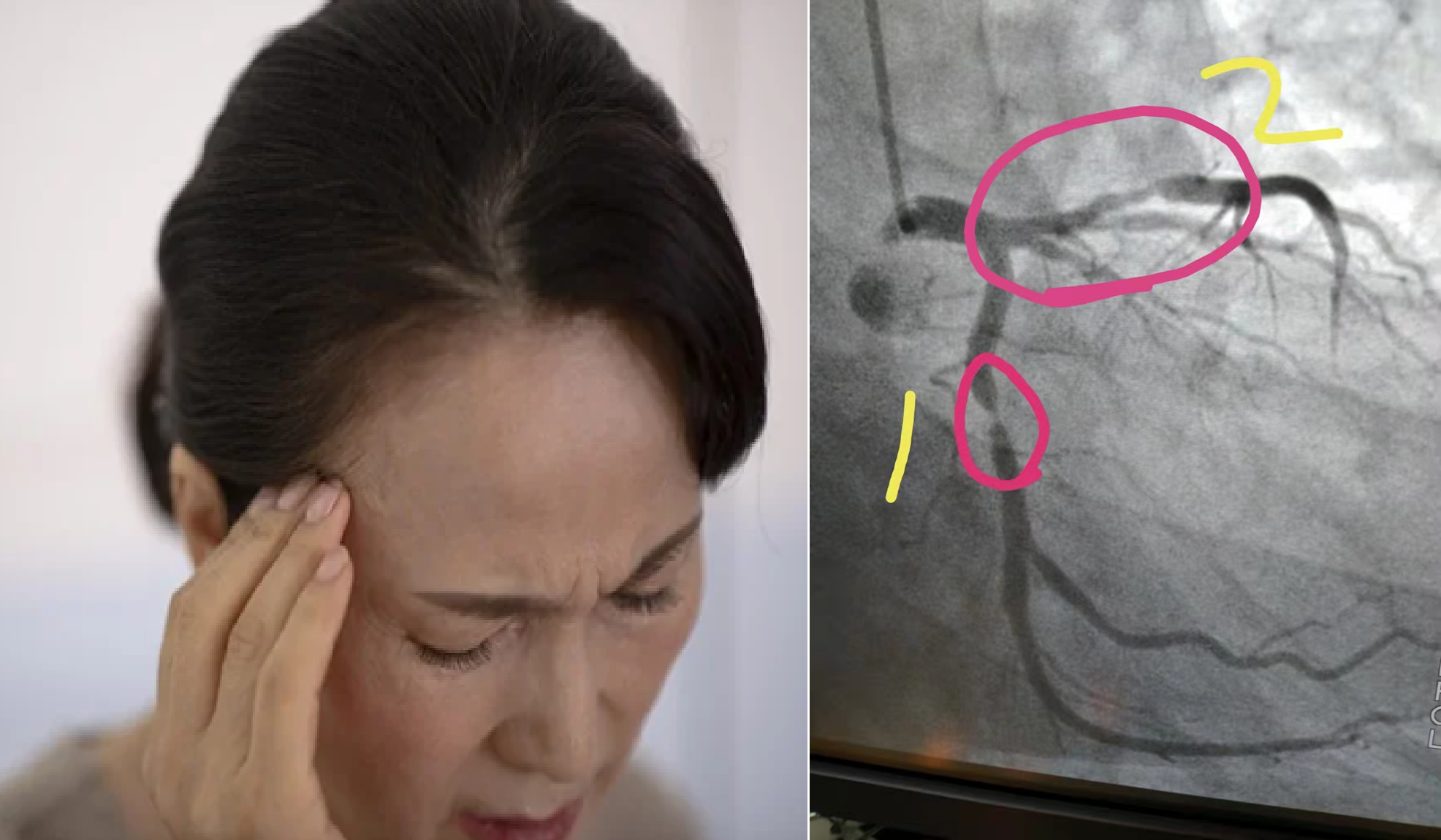 Mảng xơ vữa động mạch của người phụ nữ 53 tuổi biến mất sau 1 năm, bác sĩ tấm tắc khen: “Duy trì 6 thói quen thế mà lại hay”- Ảnh 1.