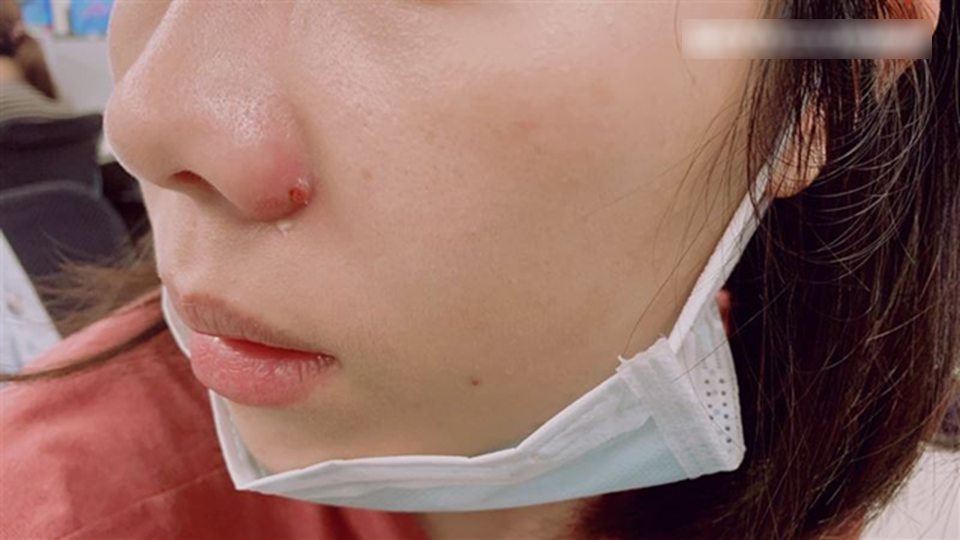 Nặn mụn quanh miệng, người phụ nữ bị sưng tấy từ môi lên tận sống mũi, bác sĩ cảnh báo: Sai lầm ở 1 điểm!- Ảnh 1.