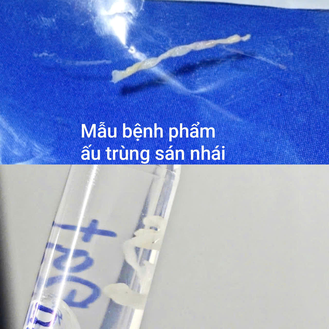 Bác sĩ kéo "thứ lạ" dài 7cm trong đùi người đàn ông Hà Nội: Nghi do một lần đi tắm cùng bạn bè- Ảnh 1.