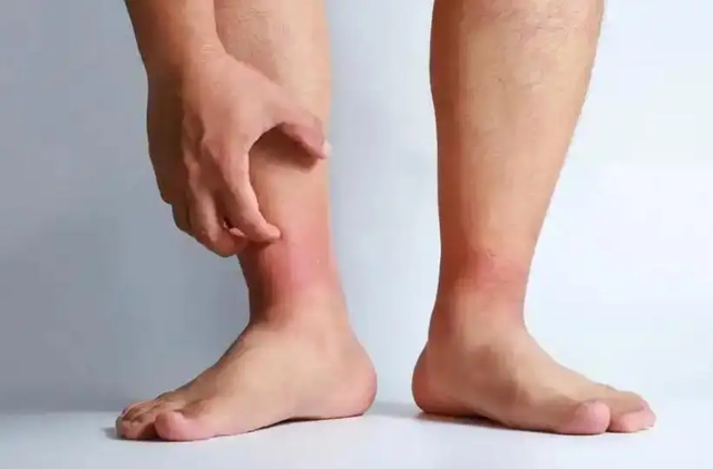 Chân sưng một bên, tuyệt đối đừng chủ quan: Cảnh báo dấu hiệu cục máu đông đang hình thành- Ảnh 1.