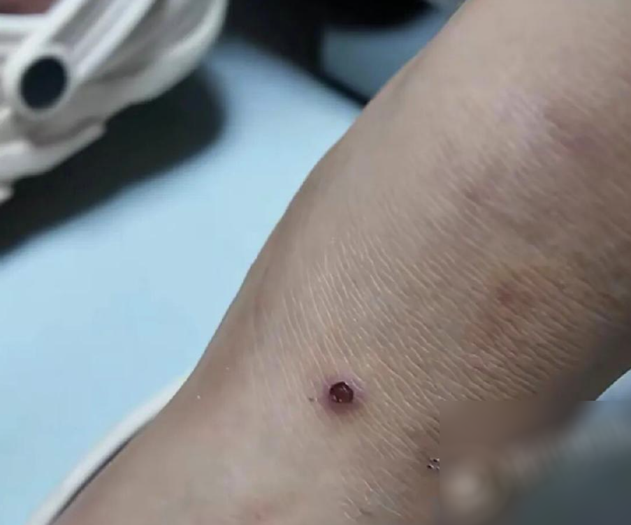 Cô gái mọc hơn 20 nốt mụn cóc khắp cơ thể, nguồn lây nhiễm là nơi không ai ngờ tới, có người còn tiếp xúc hàng ngày - Ảnh 1.