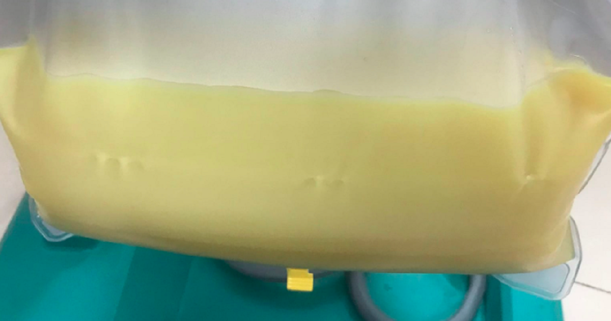 Người phụ nữ 32 tuổi máu "trắng đục như sữa", bác sĩ "chỉ mặt điểm tên" thói quen ít ai ngờ