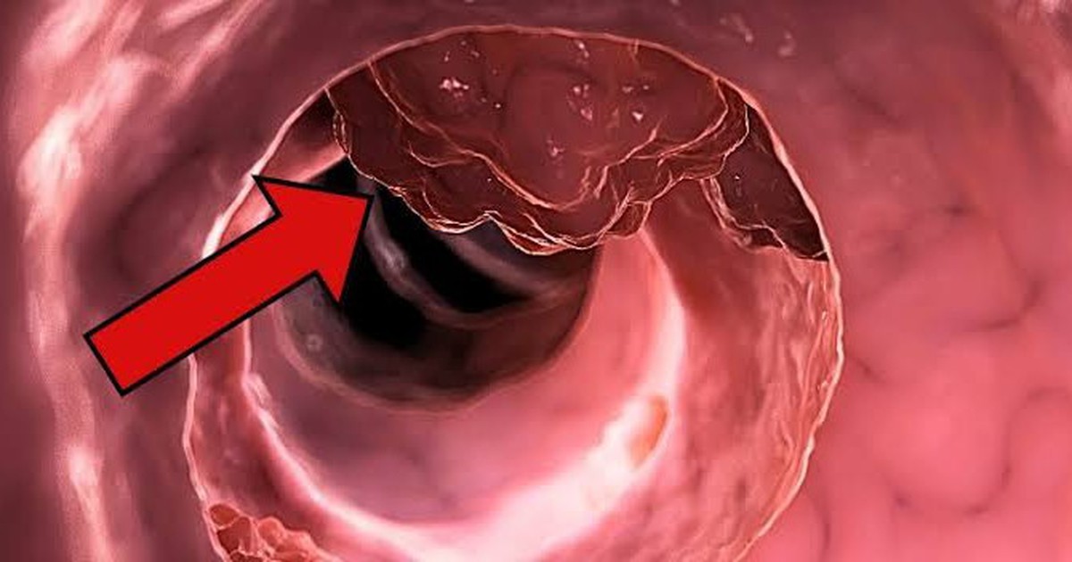Khảo sát 522 người tử vong vì ung thư đại trực tràng phát hiện 3 điểm chung đáng chú ý