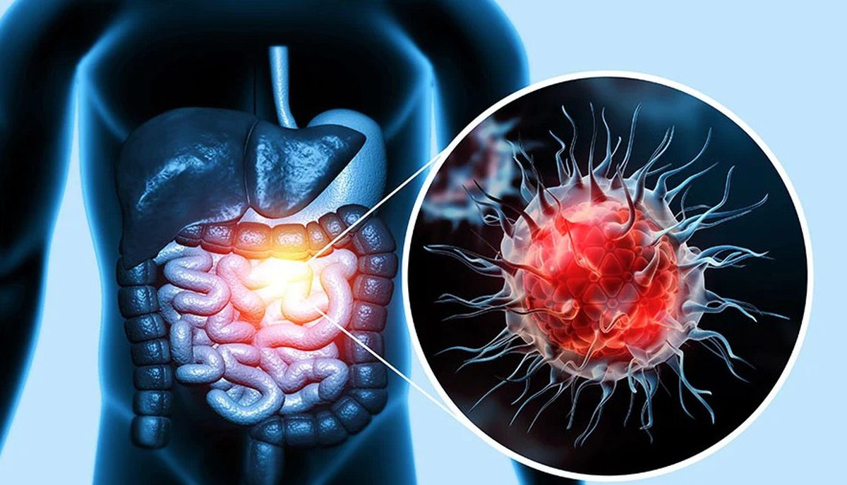 Ung thư đại trực tràng gia tăng đáng báo động: 4 dấu hiệu ở xa “tít tắp” có thể cảnh báo sớm