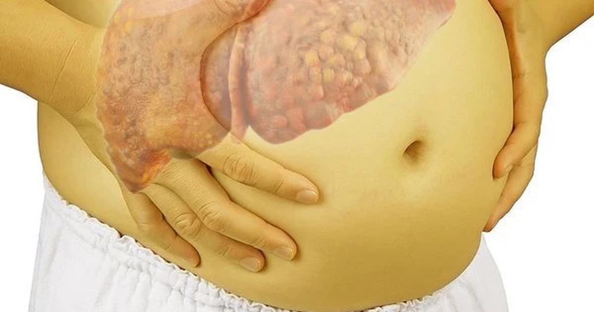 Nhiều người Việt xơ gan, ung thư gan chỉ vì dùng 1 thứ tưởng "lành tính": Bác sĩ cảnh báo