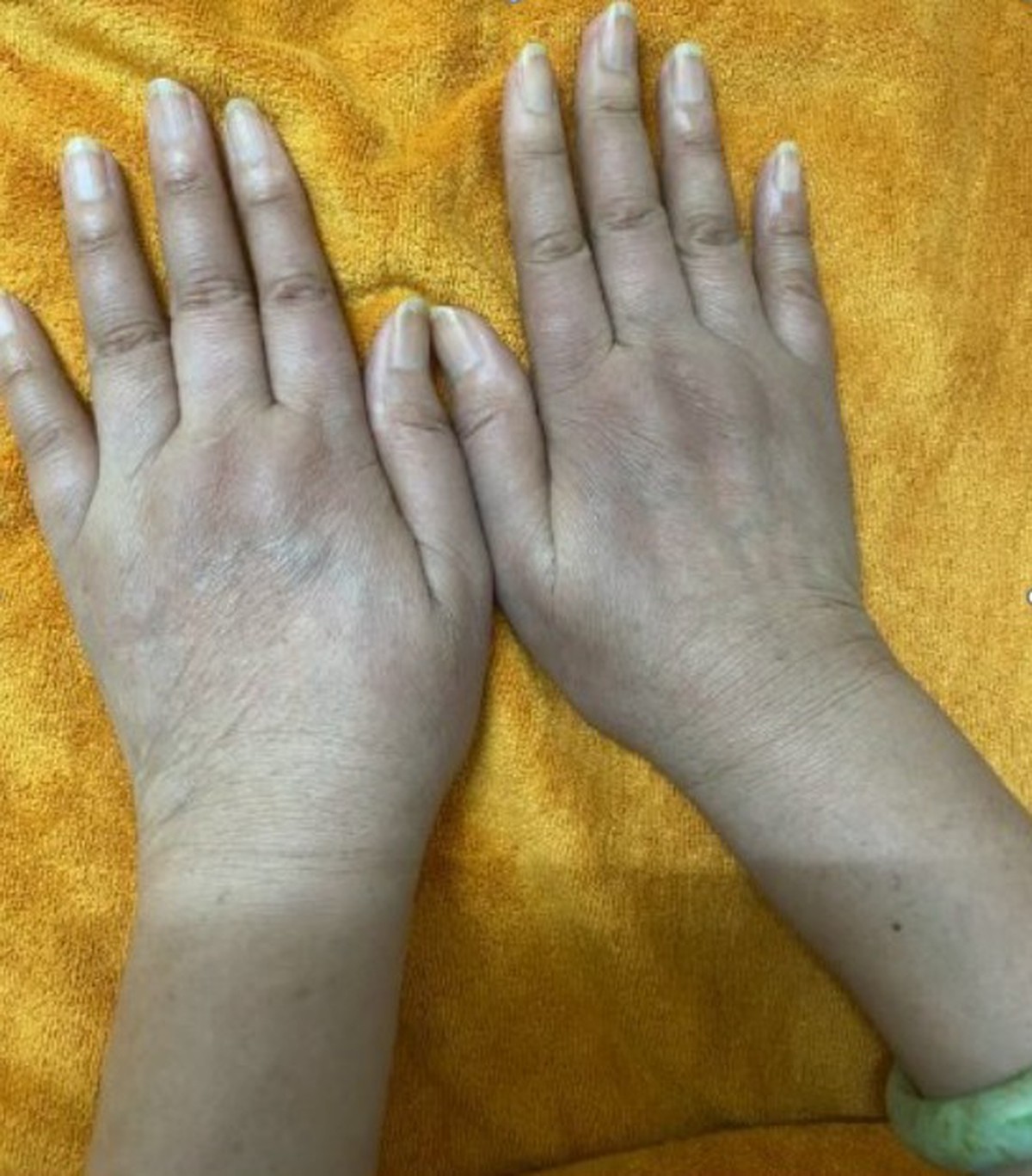 Nữ doanh nhân có 1 dấu hiệu lạ ở tay nhiều năm: Đi khám bác sĩ cảnh báo hàng loạt tạng đang "gặp nguy