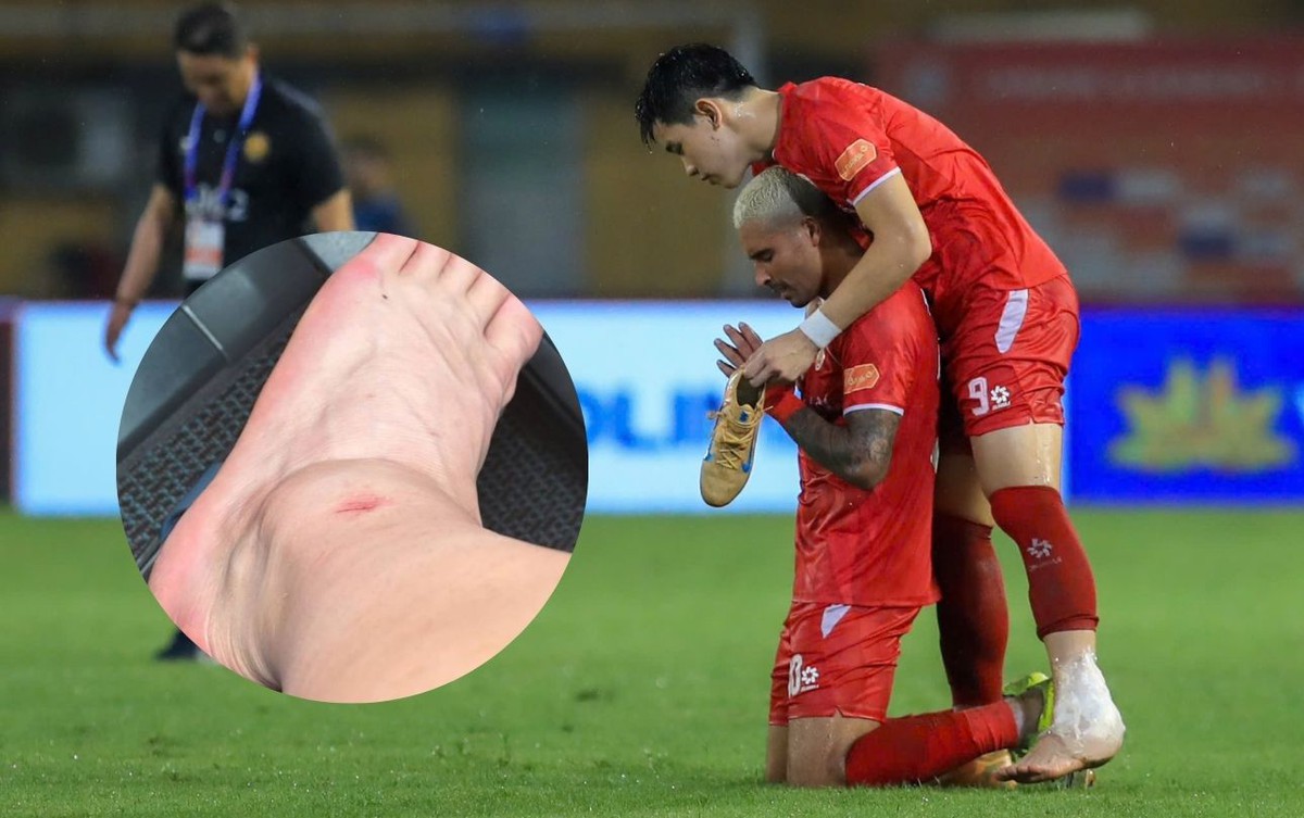 Đình Bắc lộ ảnh cổ chân sưng biến dạng sau trận vô địch V.League cùng CLB CAHN