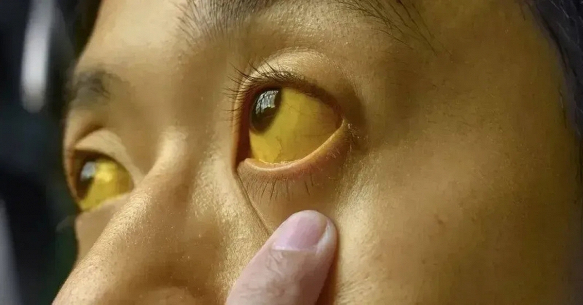 Nếu mắt có 6 thứ, đi khám ung thư ngay còn kịp!