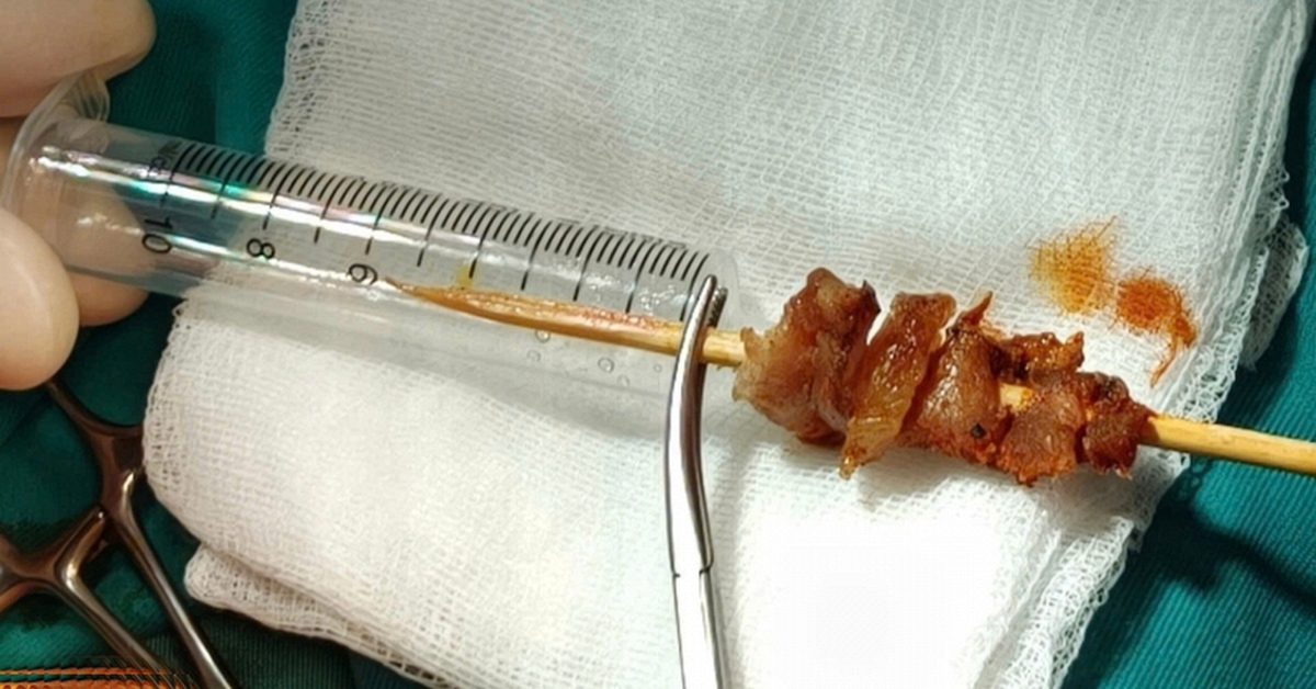 Kích hoạt toàn Bệnh viện Việt Đức cấp cứu bé gái 2,5 tuổi bị que xiên thịt đâm sâu, nguy cơ xuyên sọ não