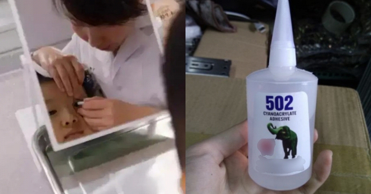 Cậu bé 3 tuổi bắt chước bà nhưng nhỏ nhầm keo 502 vào mắt: Mẹ sơ cứu trong 15 phút, bác sĩ nói "không cần điều trị nữa"