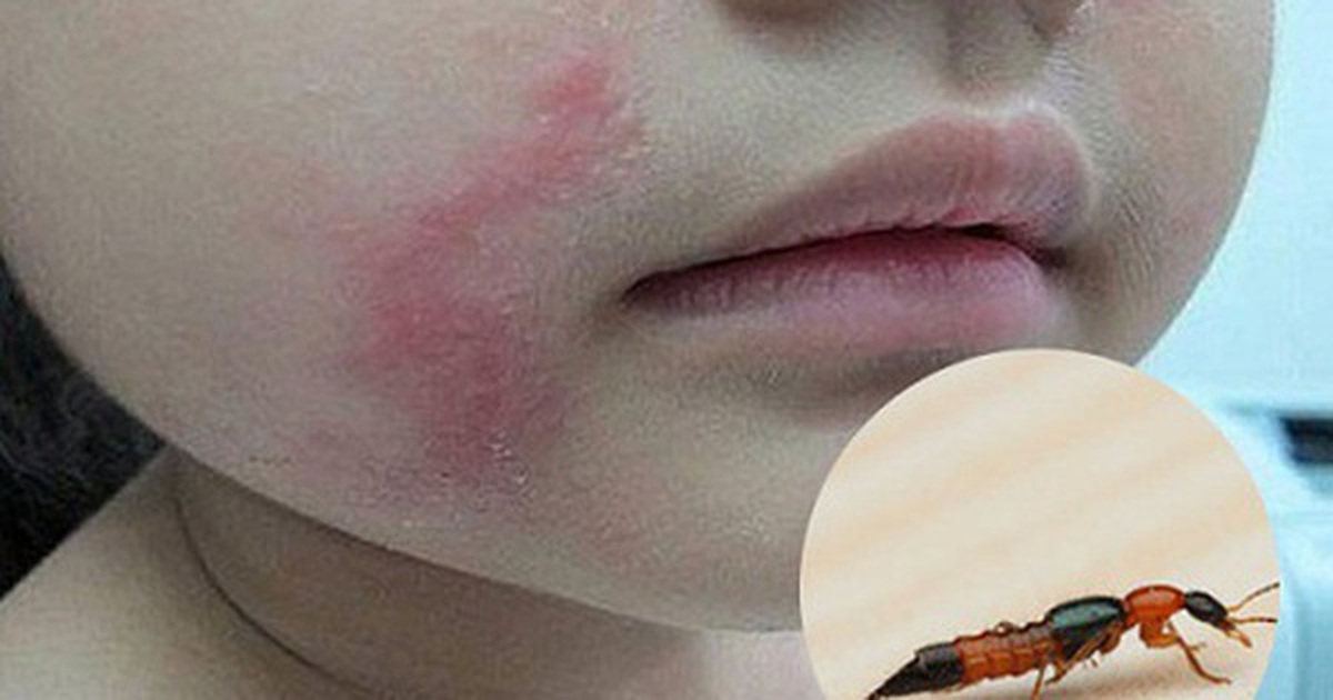 Bác sĩ BV Bạch Mai cảnh báo căn bệnh viêm da do một loại côn trùng gây ra: Cực độc, rất dễ nhầm lẫn với bệnh Zona và gặp nhiều vào mùa hè