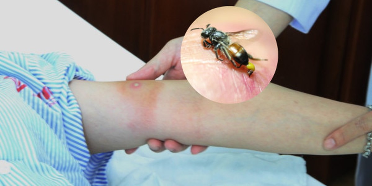 Bị ong đốt đừng vội hoảng: 7 thứ có sẵn trong nhà có thể giúp giảm sưng đau nhanh chóng, thứ đầu tiên hầu như ai cũng có