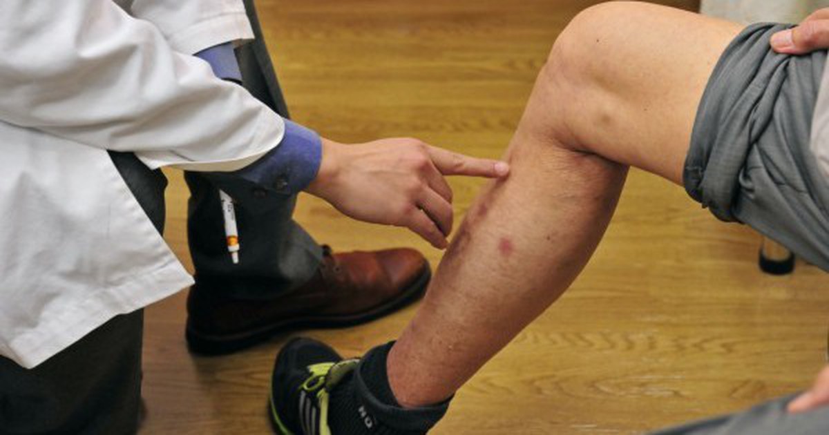 Các bác sĩ nói thẳng: Bắp chân là "đèn báo" đột quỵ, thấy 5 thứ phải đến bệnh viện ngay!