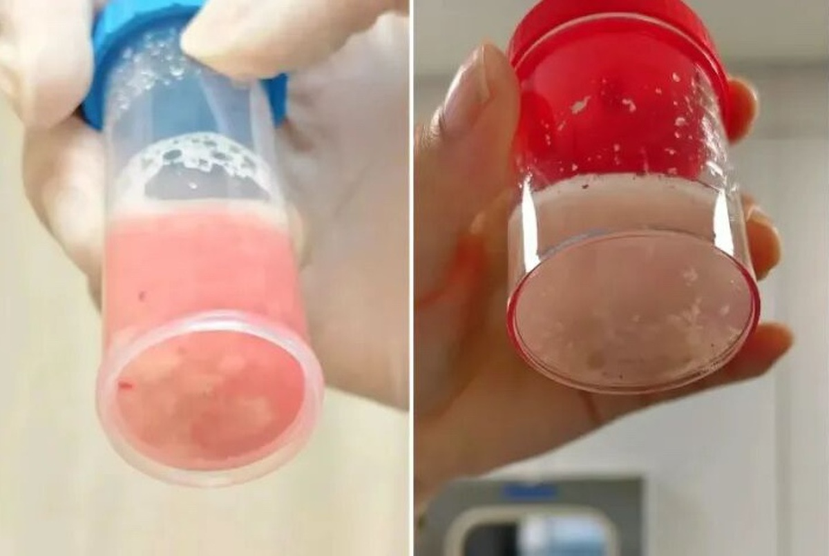 Cô bé 12 tuổi phổi trắng xóa và đông đặc sau 1 ngày bị sốt, bác sĩ cảnh báo: Đừng lúc nào cũng tưởng con cảm lạnh!