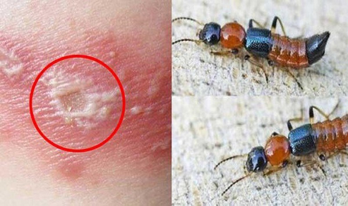 5 bước xử lý đúng cách khi tiếp xúc với kiến 3 khoang