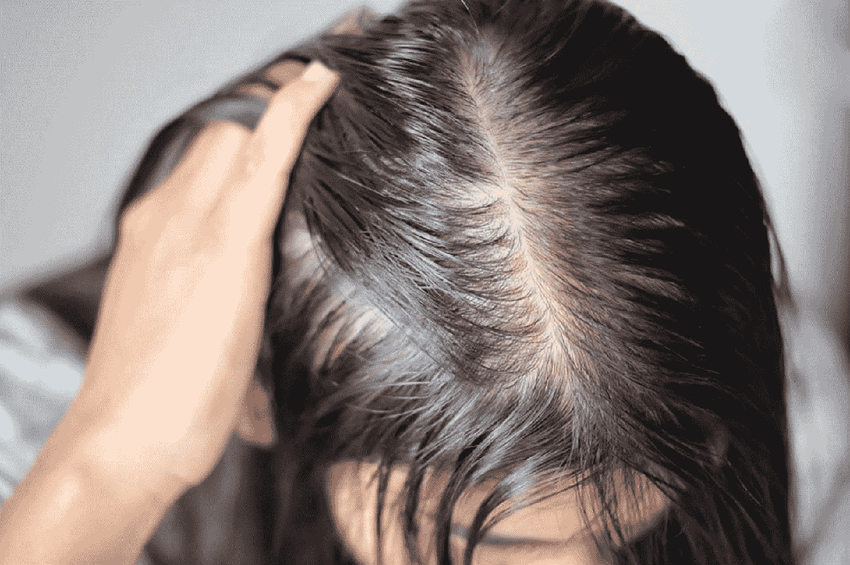 Tưởng stress vì thi cử nên rụng tóc, cô gái 22 tuổi phát hiện căn bệnh đang âm thầm đang phá hủy thận