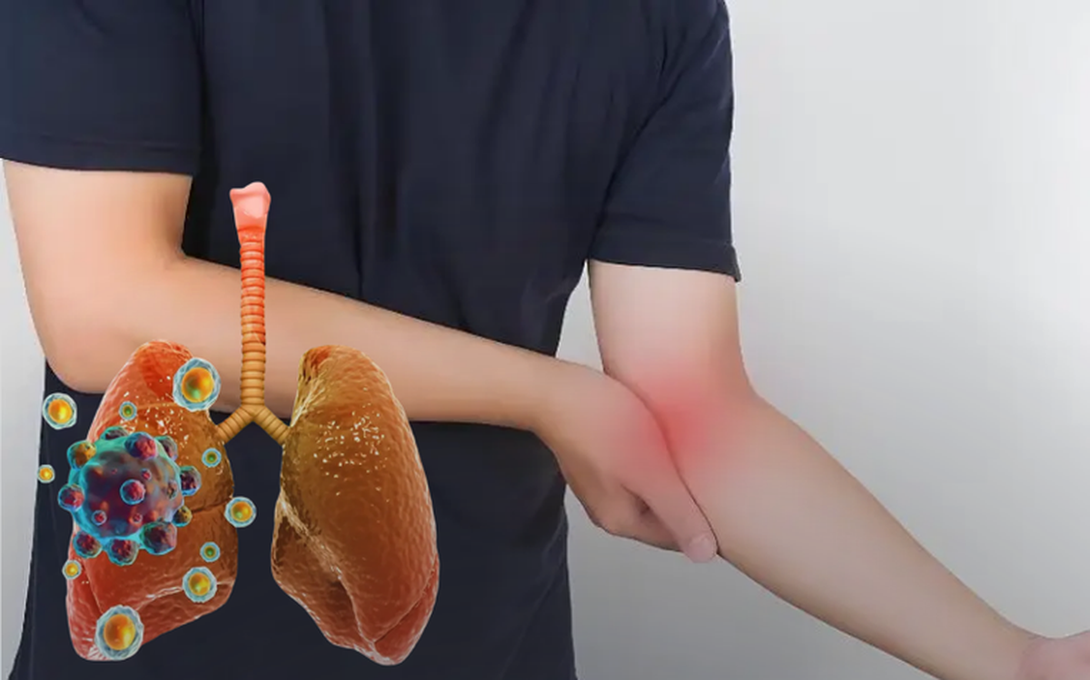 Ung thư phổi thường được chẩn đoán ở giai đoạn muộn: Nếu cảm thấy "1 chỗ sần sùi, 1 chỗ tê bì và 2 cơn đau", hãy đi khám sớm