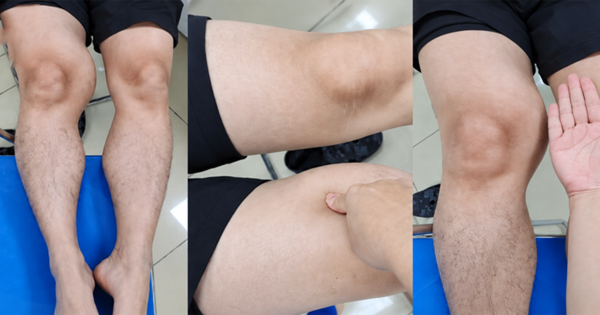 Đùi phình to như quả bóng suốt 1 năm, đi khám phát hiện ung thư hiếm gặp