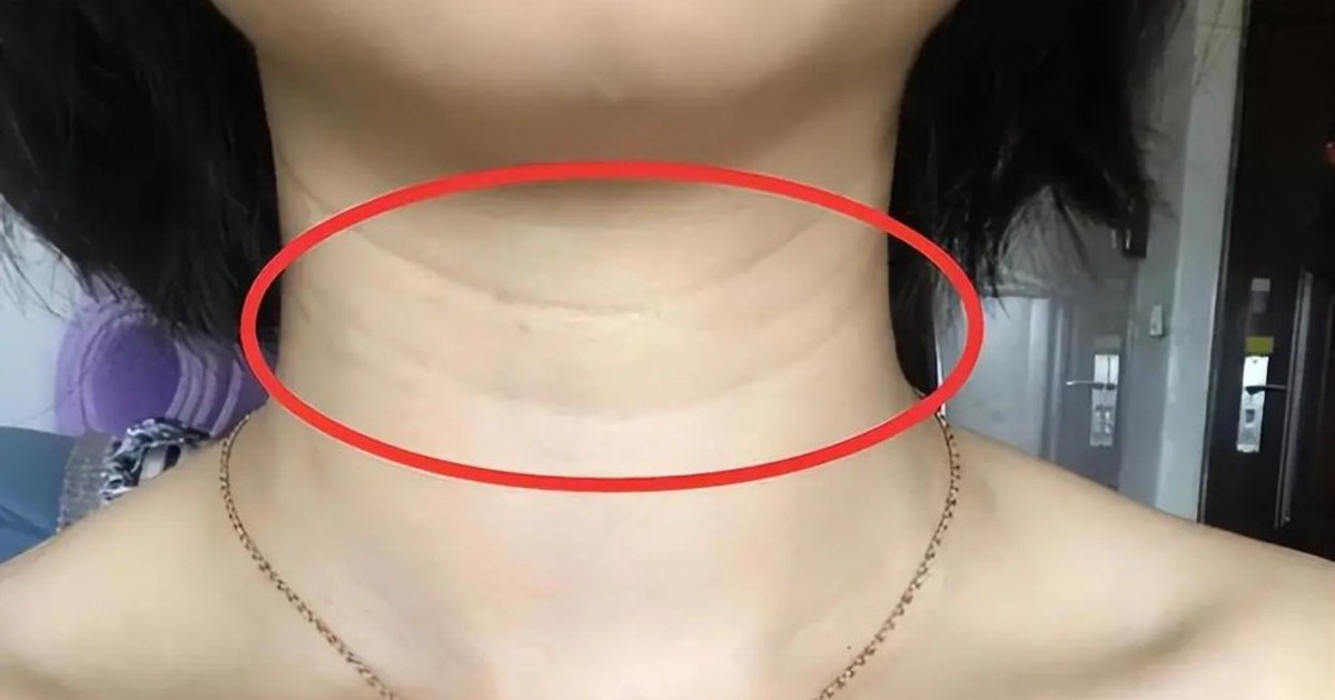 Một khi 3 hiện tượng này xuất hiện trên cổ bạn: Đừng bất cẩn, nên đi khám ngay