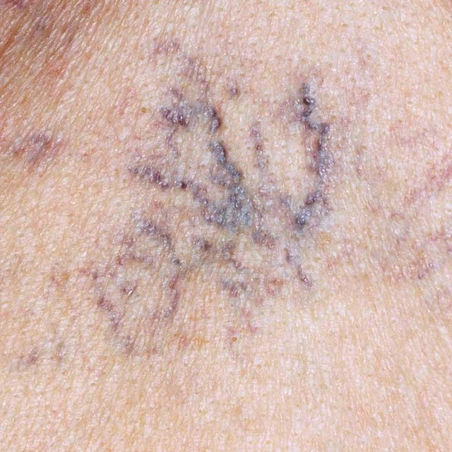 
Các vết bầm tím trên da là dấu hiệu chức năng gan suy giảm.
