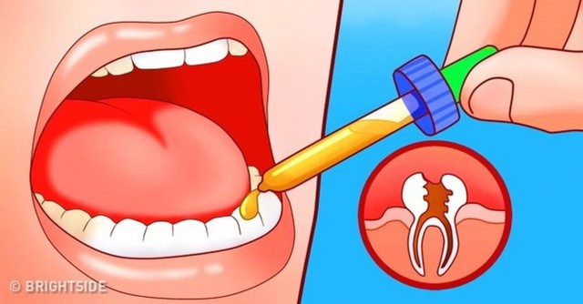 11 cách giúp bạn dịu cơn đau do mọc răng khôn - Ảnh 6.