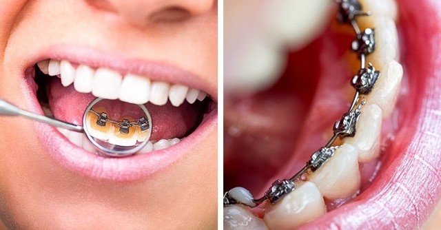 8 sai lầm phổ biến gây hại răng miệng: Chắc chắn ai cũng dính ít nhất một cái - Ảnh 6.