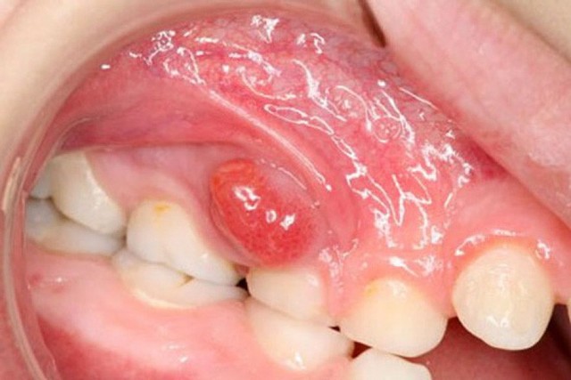 Chuyện gì sẽ xảy ra nếu bạn có một chiếc răng sâu và không chịu chữa trị ngay? - Ảnh 2.