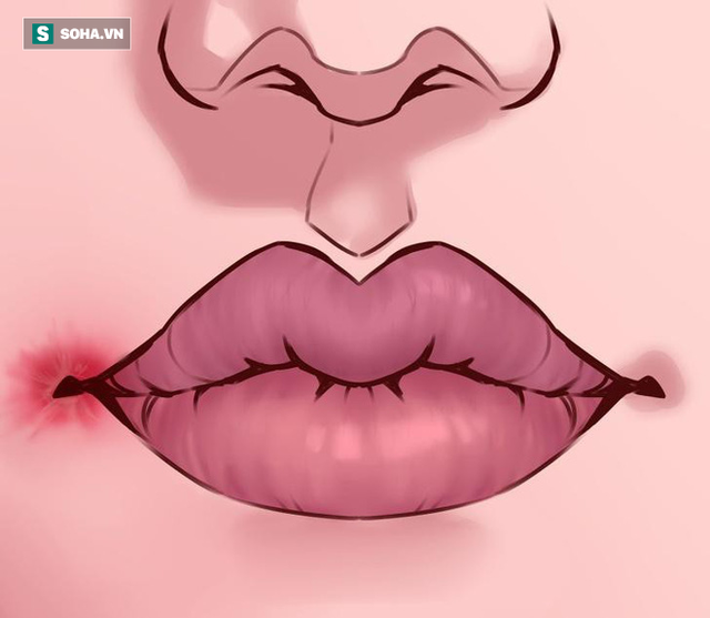 8 dấu hiệu của đôi môi cần đặc biệt chú ý vì sức khoẻ của bạn đang gặp vấn đề - Ảnh 1.