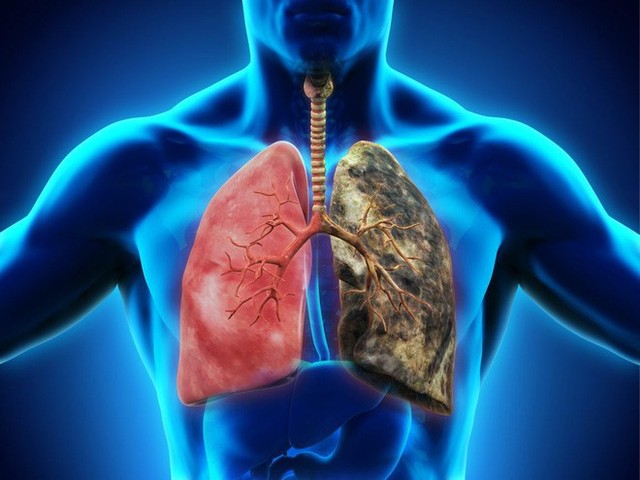  Đau lưng có phải là triệu chứng sớm của ung thư phổi: Bác sĩ chỉ cách nhận biết quan trọng - Ảnh 2.