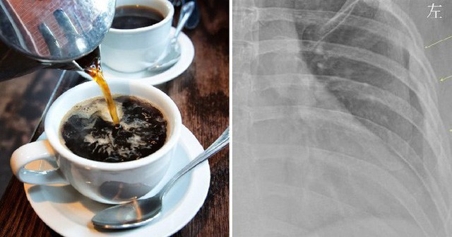 Người phụ nữ 30 tuổi này đã uống 10 tách cà phê mỗi ngày và bác sĩ đã sửng sốt khi nhìn kết quả X-quang của cô - Ảnh 1.