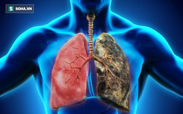  Người khỏe trước hết nhờ phổi: 6 việc giúp giải phóng phổi khỏi bệnh tật, ung thư - Ảnh 1.