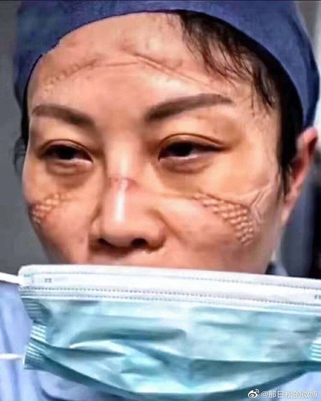 Gương mặt đầy vết hằn do khẩu trang, kính bảo hộ: Các y tá, bác sĩ ở Vũ Hán đã đánh cược cả tính mạng để chống lại đại dịch corona - Ảnh 5.