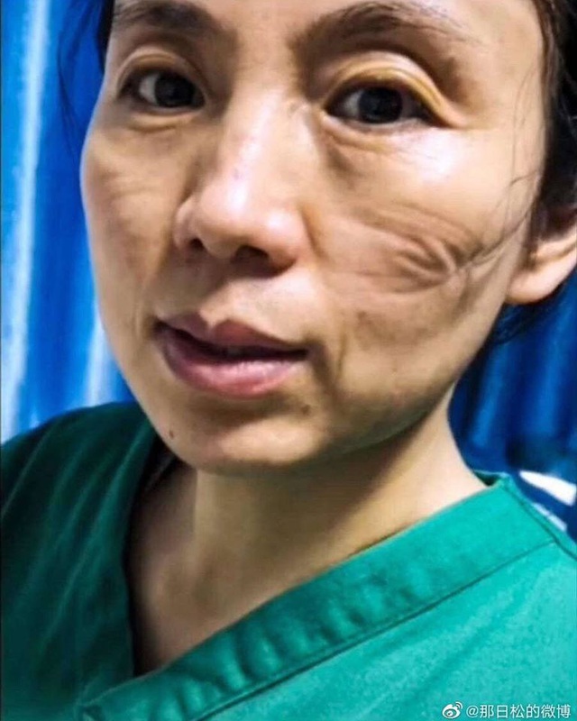 Gương mặt đầy vết hằn do khẩu trang, kính bảo hộ: Các y tá, bác sĩ ở Vũ Hán đã đánh cược cả tính mạng để chống lại đại dịch corona - Ảnh 2.