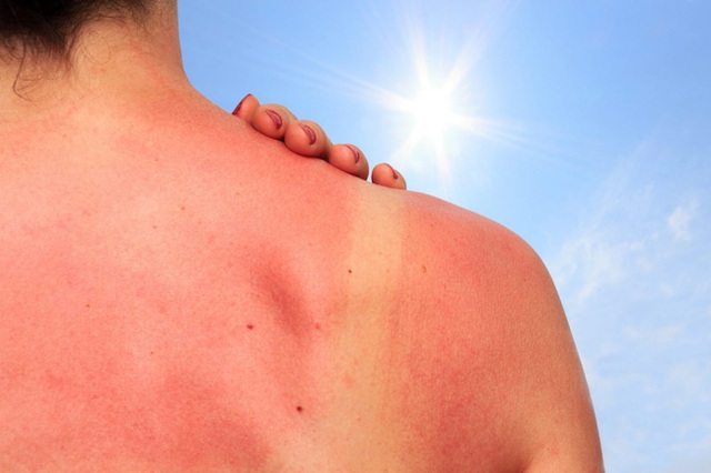 Vết cháy nắng có thể tồn tại bao lâu trên da và biện pháp làm dịu vết cháy nắng, phục hồi da nhanh hơn - Ảnh 1.