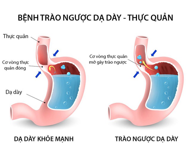 Trào ngược dạ dày: Bệnh của “thời đại mới”, tác nhân lớn nhất gây ung thư dạ dày và 7 điều buộc phải làm để không rơi vào cảnh bệnh tình - Ảnh 1.