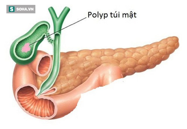 4 thói quen phổ biến có thể khiến bạn bị cắt bỏ túi mật: Ngăn ngừa sỏi và ung thư thế nào? - Ảnh 2.