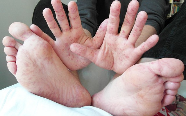 2 dấu hiệu biến chứng cực kỳ nguy hiểm của bệnh tay chân miệng cha mẹ cần nắm để theo dõi kỹ - Ảnh 1.