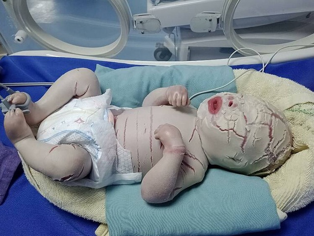  Trong 2 tuần, Việt Nam có tới 2 bé sơ sinh mắc da vảy cá: Căn bệnh này nghiêm trọng thế nào? - Ảnh 1.