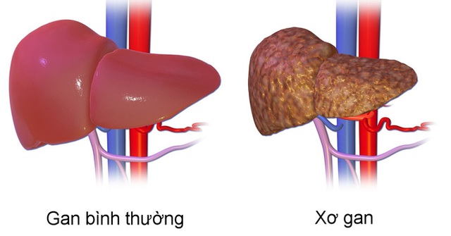  7 nhóm người có lá gan phản chủ: Hãy cẩn thận vì nó đang xơ hóa, có thể dẫn đến ung thư - Ảnh 1.