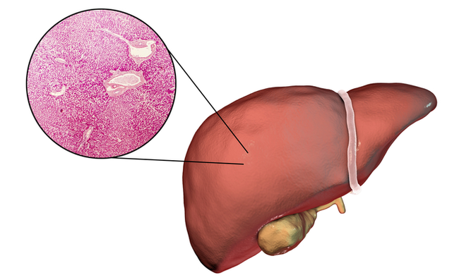  7 nhóm người có lá gan phản chủ: Hãy cẩn thận vì nó đang xơ hóa, có thể dẫn đến ung thư - Ảnh 3.