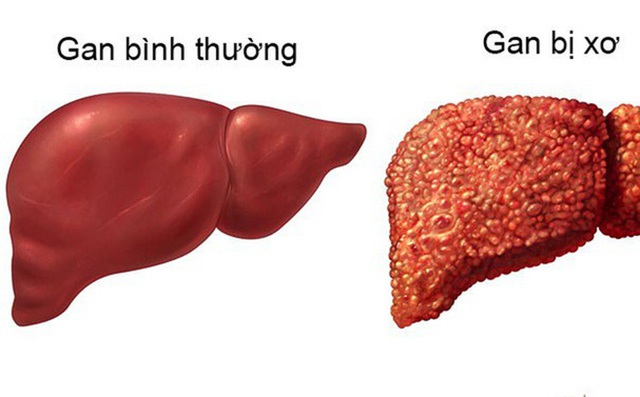 3 điều nên làm ngay để ngăn chặn xơ gan: Người có vấn đề về gan nên lưu ý sớm - Ảnh 1.