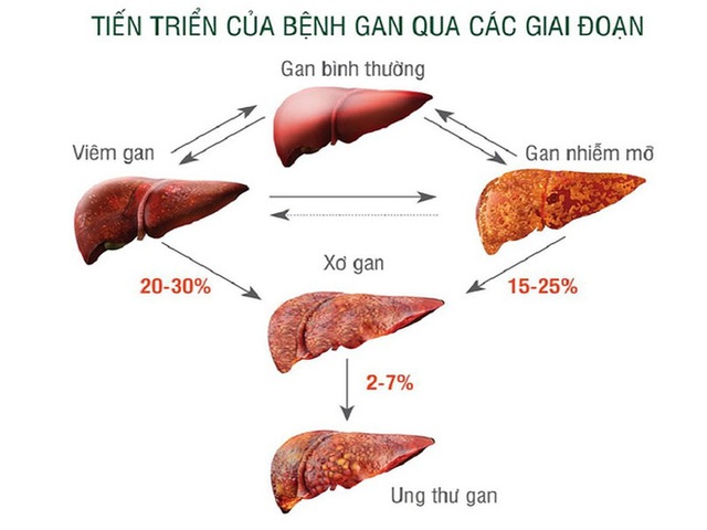 3 điều nên làm ngay để ngăn chặn xơ gan: Người có vấn đề về gan nên lưu ý sớm - Ảnh 2.