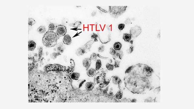 Loại virus duy nhất được cho là có thể gây bệnh ung thư máu nguy hiểm như thế nào? - Ảnh 1.