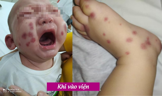 Phát hiện và điều trị thành công một ca bệnh cực hiếm chưa từng xuất hiện ở Việt Nam, cả thế giới chỉ có khoảng 300-500 trường hợp mắc - Ảnh 1.