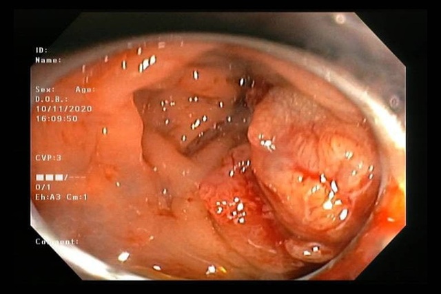 5 gạch đầu dòng để phát hiện ung thư trực tràng sớm: Dù đang khoẻ mạnh cũng cần chú ý - Ảnh 1.